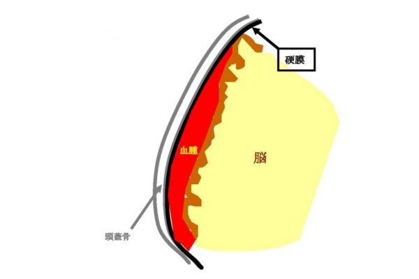 硬膜下血腫のイメージ画像